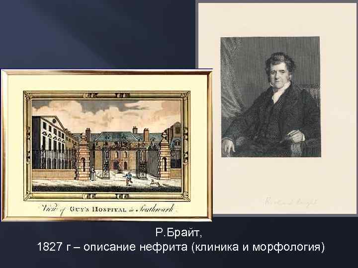 Р. Брайт, 1827 г – описание нефрита (клиника и морфология) 