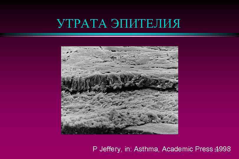 УТРАТА ЭПИТЕЛИЯ P Jeffery, in: Asthma, Academic Press 33 1998 