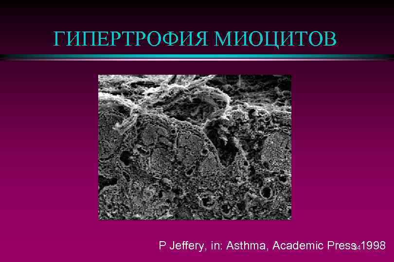 ГИПЕРТРОФИЯ МИОЦИТОВ P Jeffery, in: Asthma, Academic Press 1998 34 