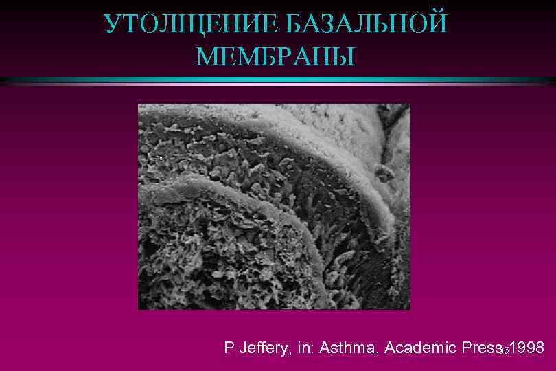 УТОЛЩЕНИЕ БАЗАЛЬНОЙ МЕМБРАНЫ P Jeffery, in: Asthma, Academic Press 1998 35 