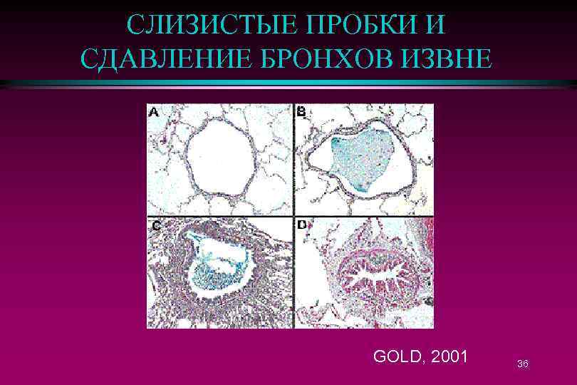 СЛИЗИСТЫЕ ПРОБКИ И СДАВЛЕНИЕ БРОНХОВ ИЗВНЕ GOLD, 2001 36 