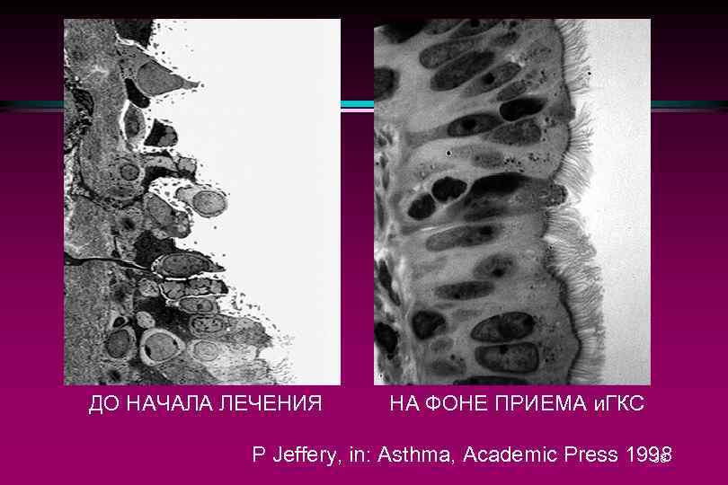ДО НАЧАЛА ЛЕЧЕНИЯ НА ФОНЕ ПРИЕМА и. ГКС P Jeffery, in: Asthma, Academic Press