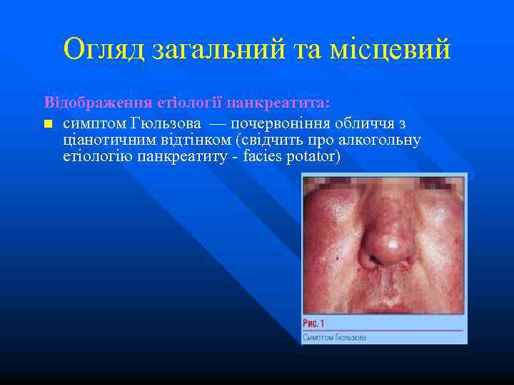 Огляд загальний та місцевий Відображення етіології панкреатита: n симптом Гюльзова — почервоніння обличчя з