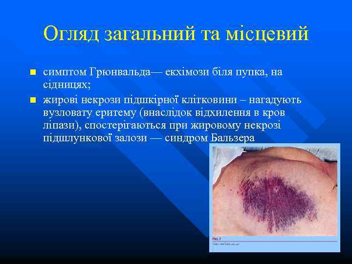 Огляд загальний та місцевий n n симптом Грюнвальда— екхімози біля пупка, на сідницях; жирові