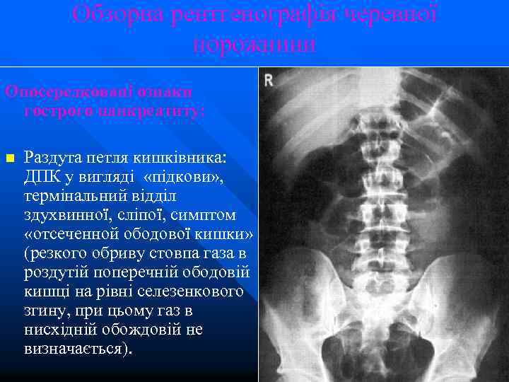 Обзорна рентгенографія черевної порожнини Опосередковані ознаки гострого панкреатиту: n Раздута петля кишківника: ДПК у