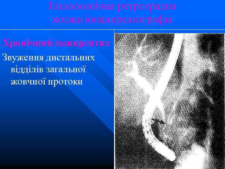 Ендоскопічна ретроградна холангіопанкреатографія Хронічний панкреатит Звуження дистальних відділів загальної жовчної протоки 