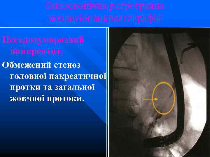 Ендоскопічна ретроградна холангіопанкреатографія Псевдотуморозний панкреатит. Обмежений стеноз головної пакреатичної протки та загальної жовчної протоки.