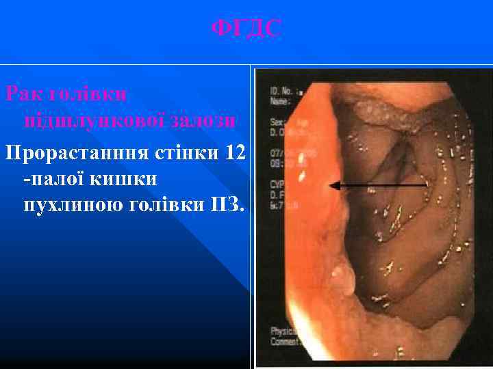 ФГДС Рак голівки підшлункової залози Прорастанння стінки 12 -палої кишки пухлиною голівки ПЗ. 