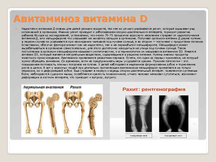 Авитаминоз витамина D Недостаток витамина Д опасен для детей раннего возраста, так как из-за