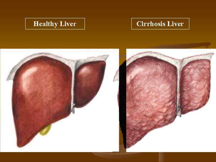 Healthy Liver Cirrhosis Liver 