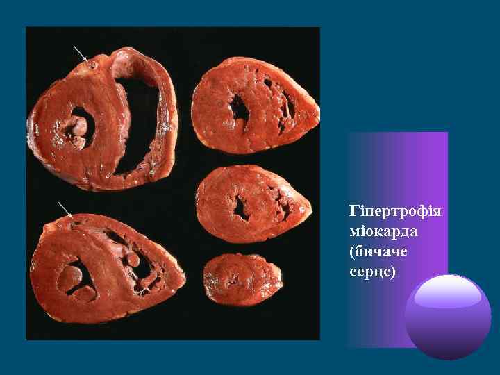 Гіпертрофія міокарда (бичаче серце) 