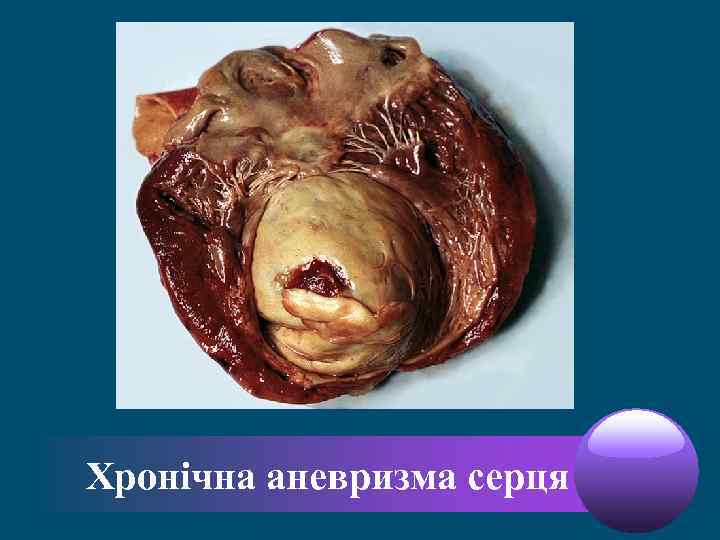 Хронічна аневризма серця 