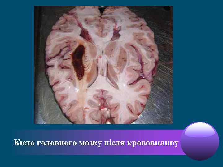 Кіста головного мозку після крововиливу 