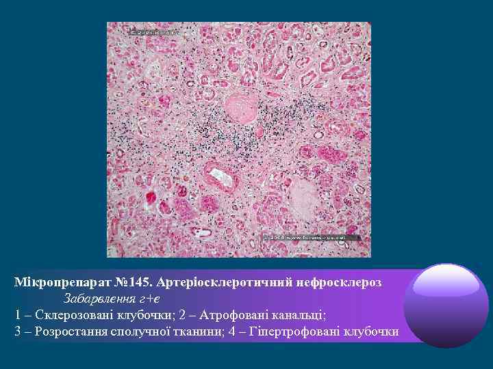 Мікропрепарат № 145. Артеріосклеротичний нефросклероз Забарвлення г+е 1 – Склерозовані клубочки; 2 – Атрофовані