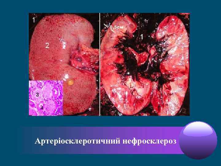 Артеріосклеротичний нефросклероз 