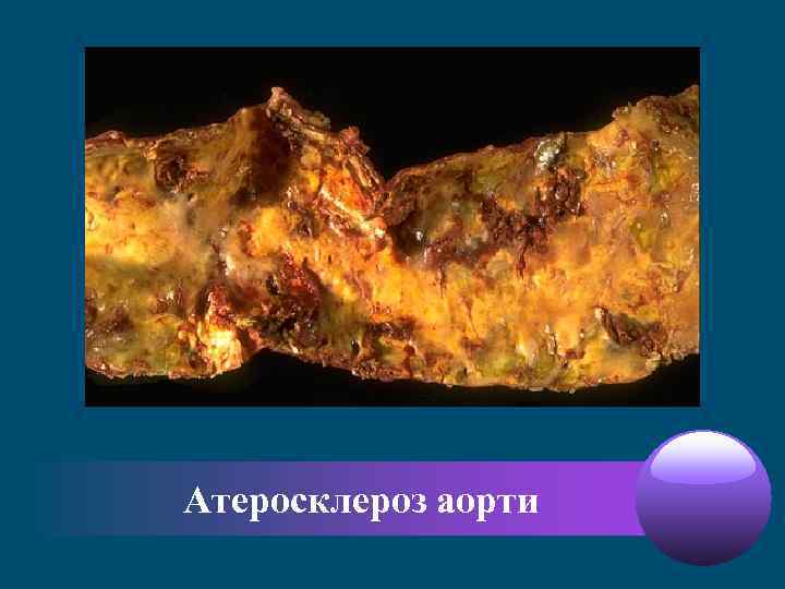 Атеросклероз аорти 