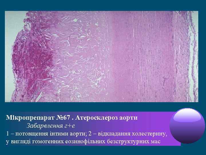 Мікропрепарат № 67. Атеросклероз аорти Забарвлення г+е 1 – потовщення інтими аорти; 2 –