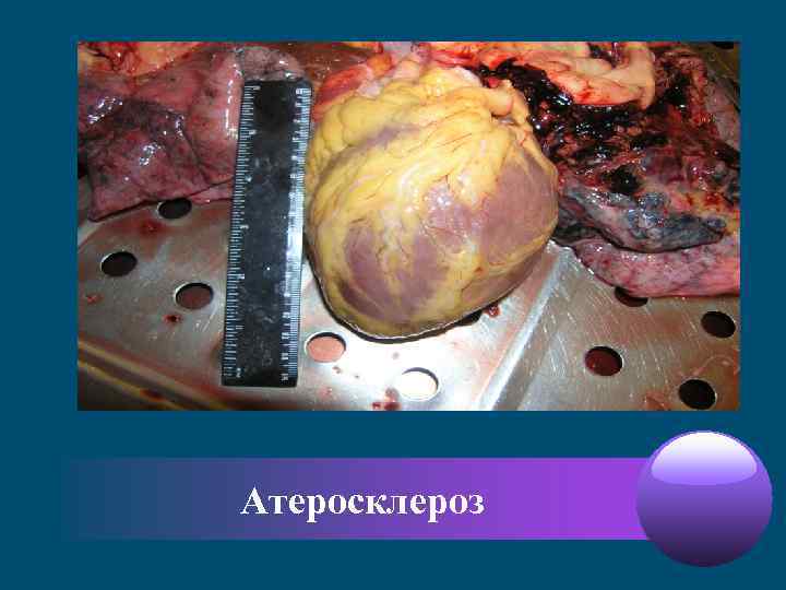 Атеросклероз 