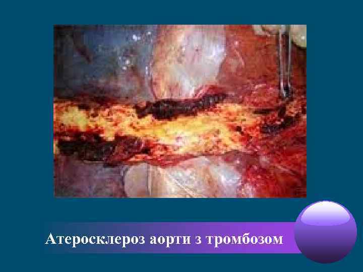 Атеросклероз аорти з тромбозом 