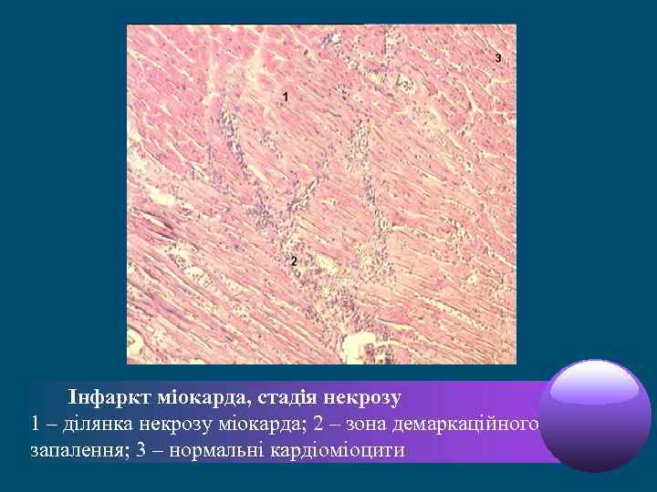  Інфаркт міокарда, стадія некрозу 1 – ділянка некрозу міокарда; 2 – зона демаркаційного