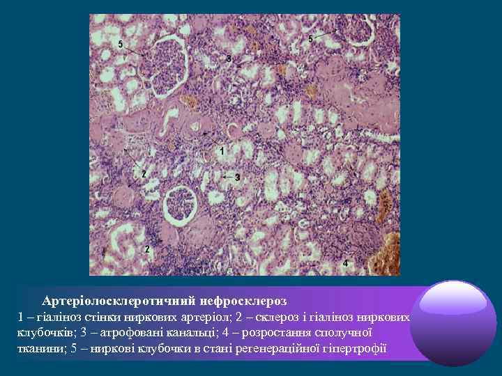  Артеріолосклеротичний нефросклероз 1 – гіаліноз стінки ниркових артеріол; 2 – склероз і гіаліноз