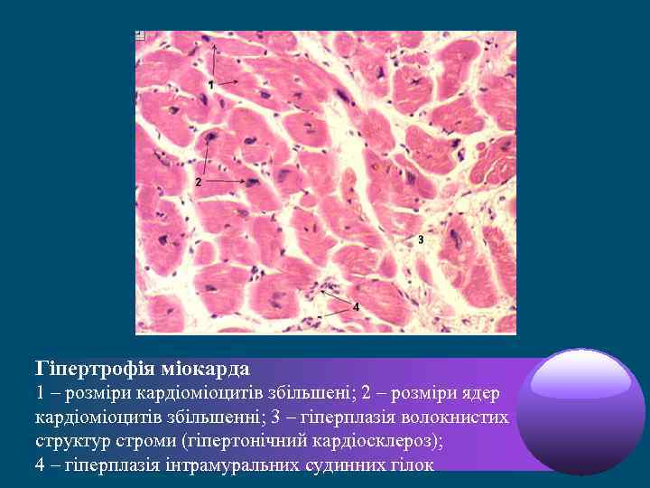 Гіпертрофія міокарда 1 – розміри кардіоміоцитів збільшені; 2 – розміри ядер кардіоміоцитів збільшенні; 3