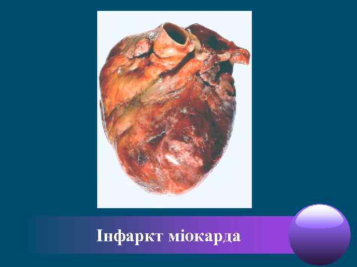 Інфаркт міокарда 