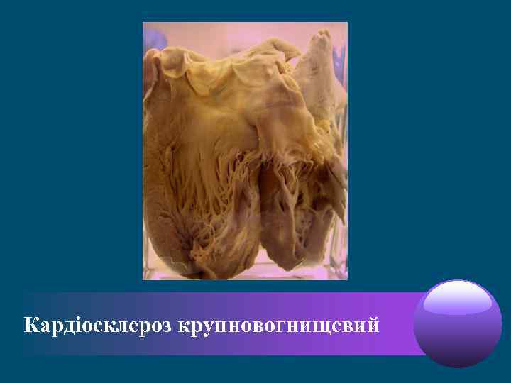 Кардіосклероз крупновогнищевий 