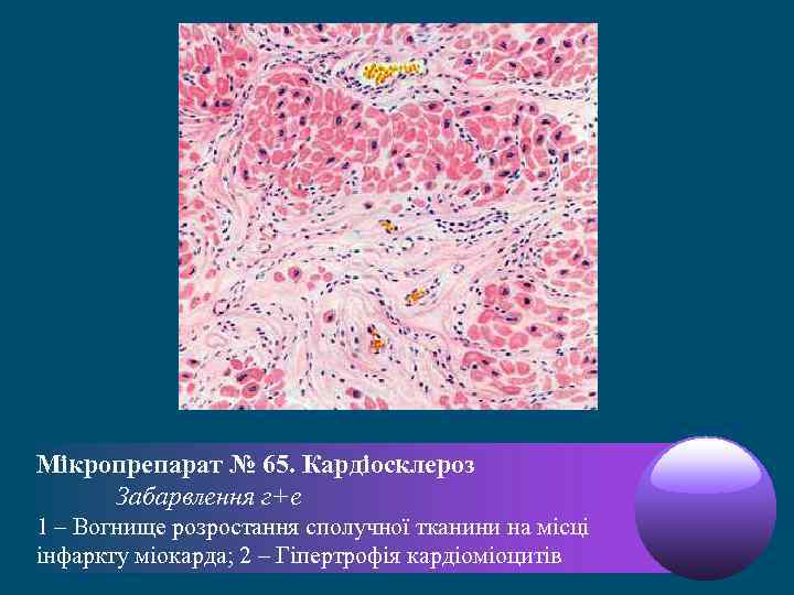 Мікропрепарат № 65. Кардіосклероз Забарвлення г+е 1 – Вогнище розростання сполучної тканини на місці