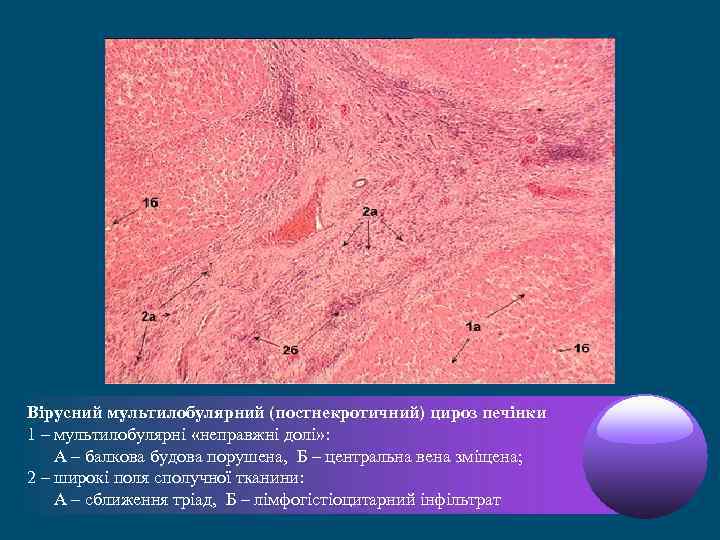 Вірусний мультилобулярний (постнекротичний) цироз печінки 1 – мультилобулярні «неправжні долі» : А – балкова