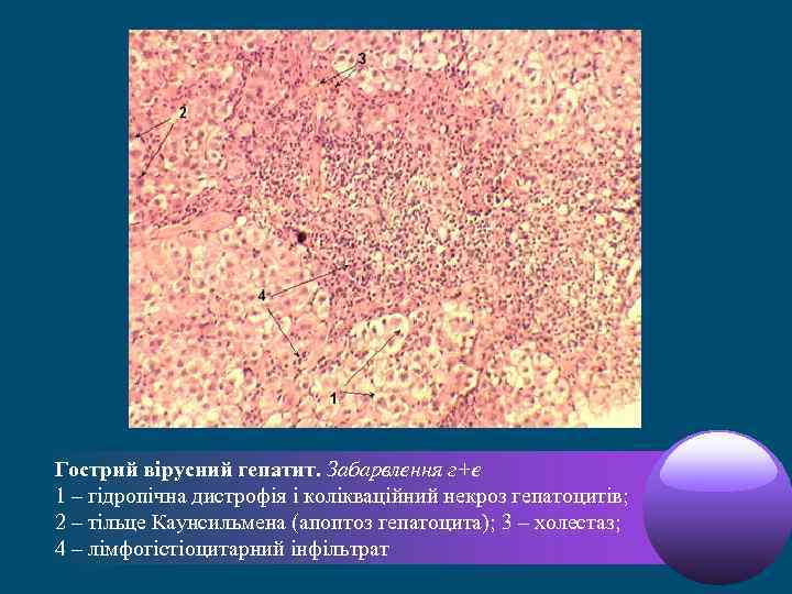 Злокачественные новообразования лимфоидной кроветворной ткани. Тельца каунсильмена это патанатомия. Электронно микроскопические изменения гепатоцитов при гепатите в. Порто-Центральный мостовидный некроз гепатоцитов.