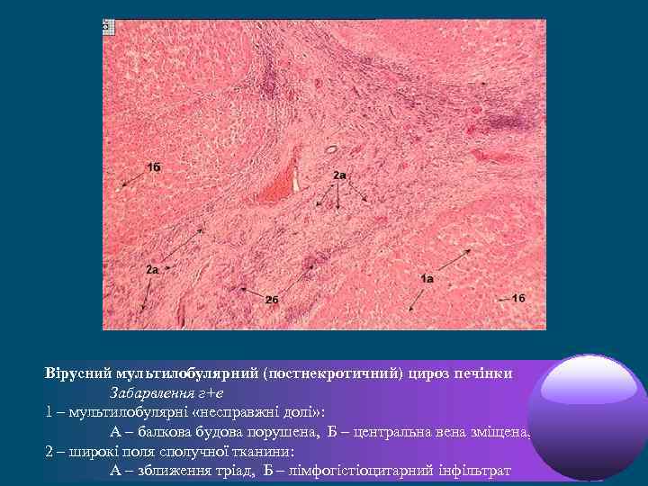 Вірусний мультилобулярний (постнекротичний) цироз печінки Забарвлення г+е 1 – мультилобулярні «неcправжні долі» : А