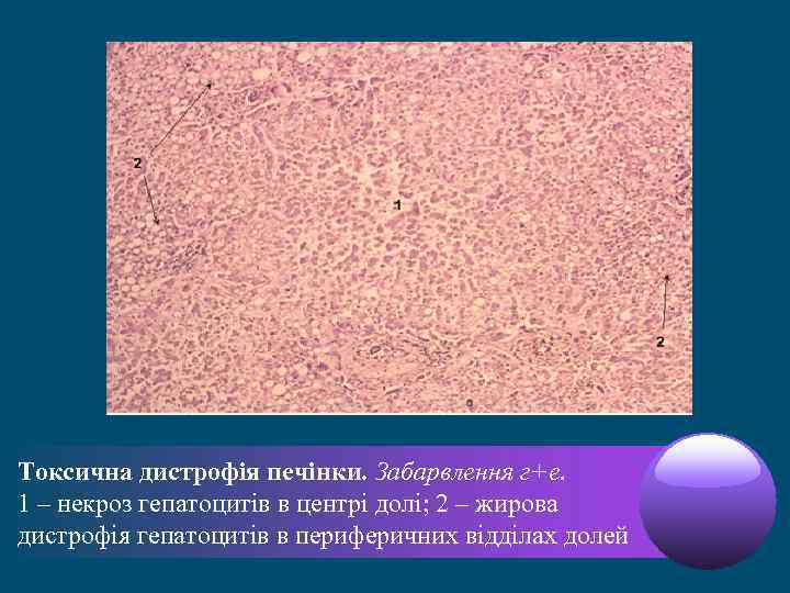 Токсична дистрофія печінки. Забарвлення г+е. 1 – некроз гепатоцитів в центрі долі; 2 –