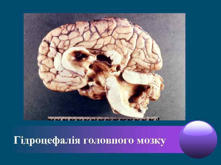 Гідроцефалія головного мозку 