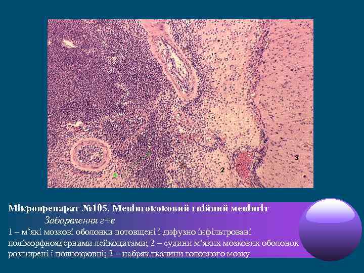 Мікропрепарат № 105. Менінгококовий гнійний менінгіт Забарвлення г+е 1 – м’які мозкові оболонки потовщені