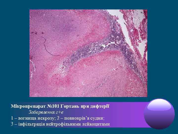 Мікропрепарат № 101 Гортань при дифтерії Забарвлення г+е 1 – вогнища некрозу; 2 –