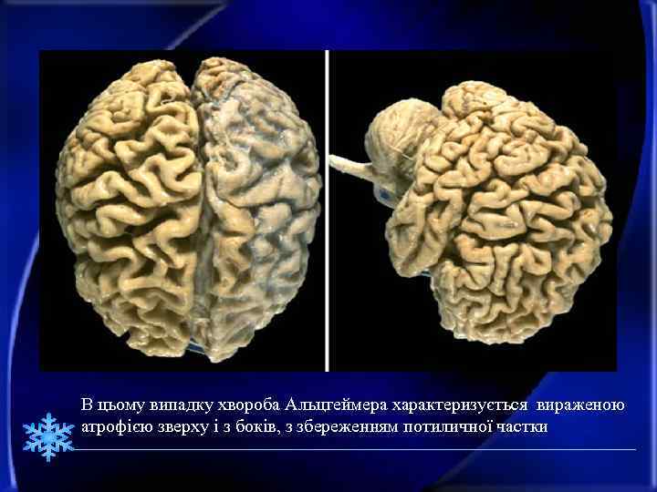 В цьому випадку хвороба Альцгеймера характеризується вираженою атрофією зверху і з боків, з збереженням