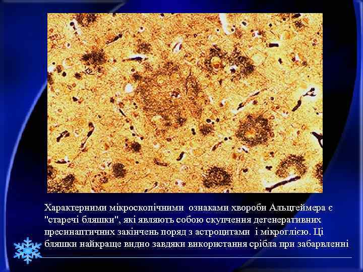 Характерними мікроскопічними ознаками хвороби Альцгеймера є "старечі бляшки", які являють собою скупчення дегенеративних пресинаптичних