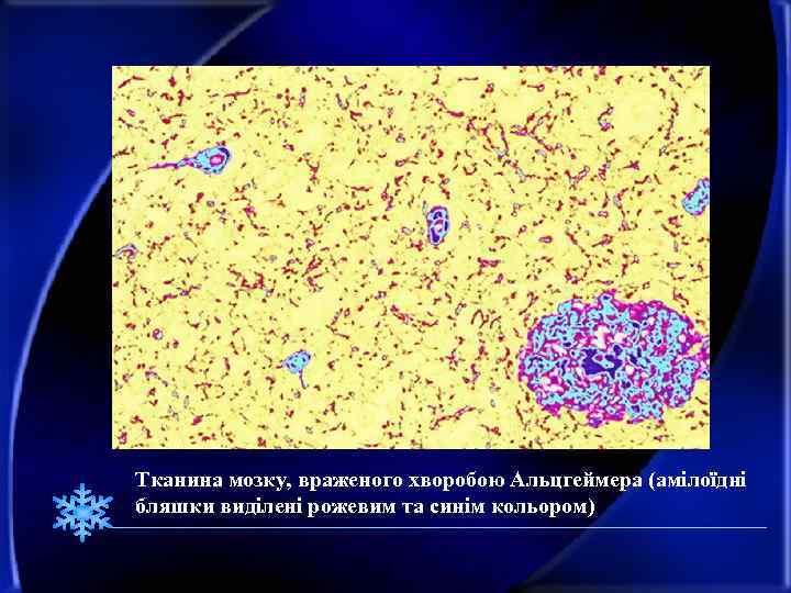 Тканина мозку, враженого хворобою Альцгеймера (амілоїдні бляшки виділені рожевим та синім кольором) 