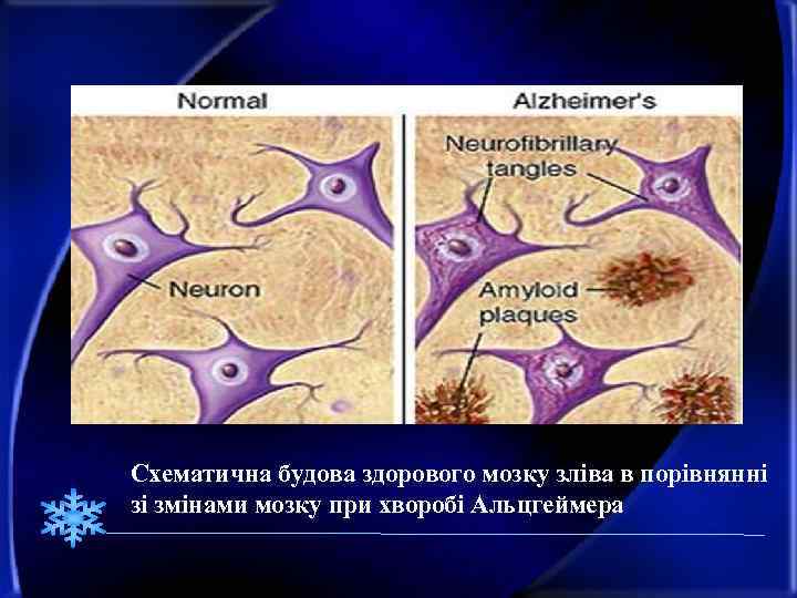 Схематична будова здорового мозку зліва в порівнянні зі змінами мозку при хворобі Альцгеймера 