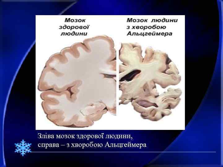 Зліва мозок здорової людини, справа – з хворобою Альцгеймера 