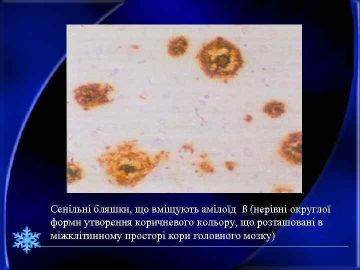 Сенільні бляшки, що вміщують амілоїд ß (нерівні округлої форми утворення коричневого кольору, що розташовані