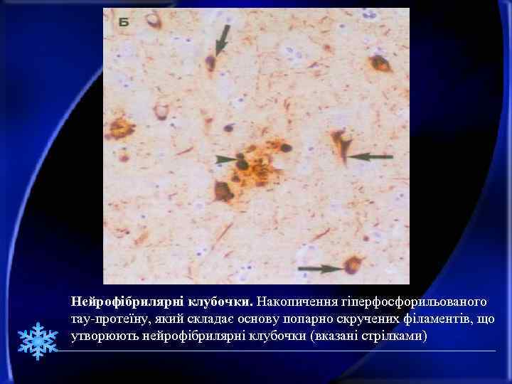 Нейрофібрилярні клубочки. Накопичення гіперфосфорильованого тау-протеїну, який складає основу попарно скручених філаментів, що утворюють нейрофібрилярні