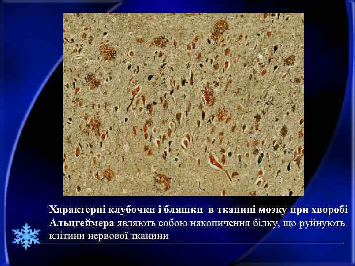 Характерні клубочки і бляшки в тканині мозку при хворобі Альцгеймера являють собою накопичення білку,