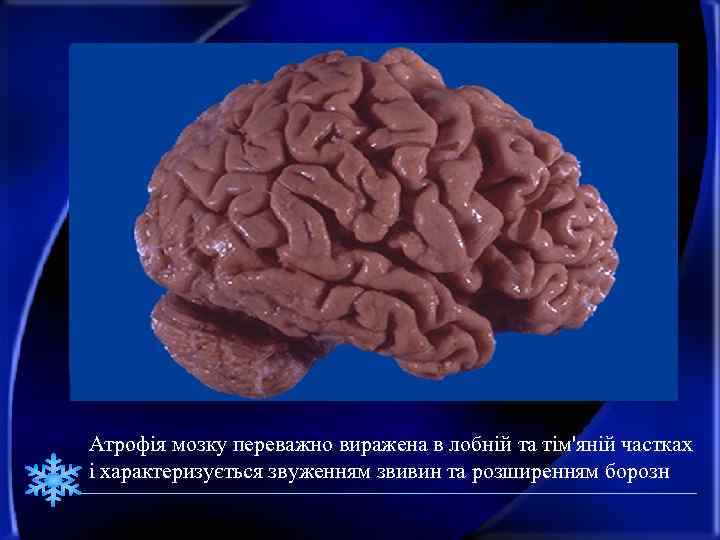 Атрофія мозку переважно виражена в лобній та тім'яній частках і характеризується звуженням звивин та