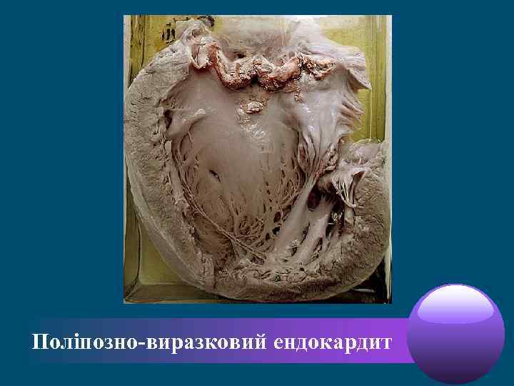 Поліпозно-виразковий ендокардит 