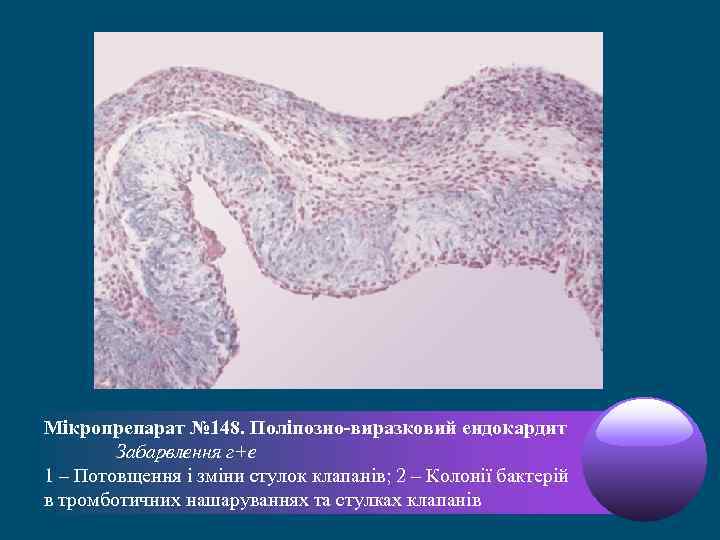 Мікропрепарат № 148. Поліпозно-виразковий ендокардит Забарвлення г+е 1 – Потовщення і зміни стулок клапанів;