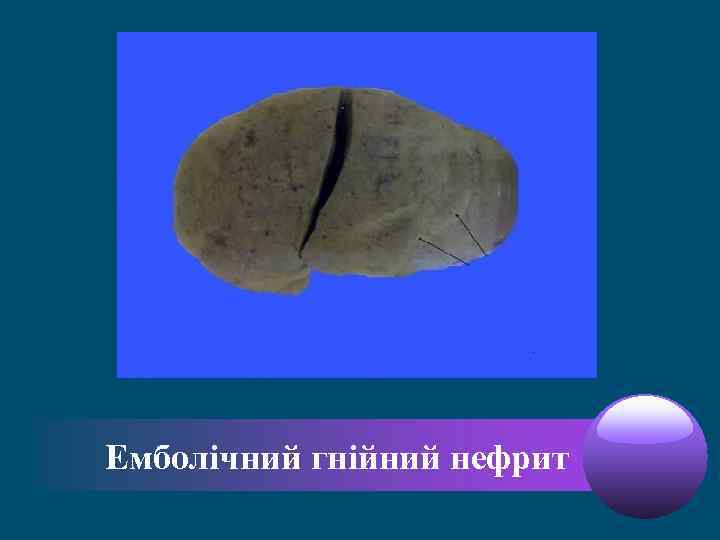 Емболічний гнійний нефрит 