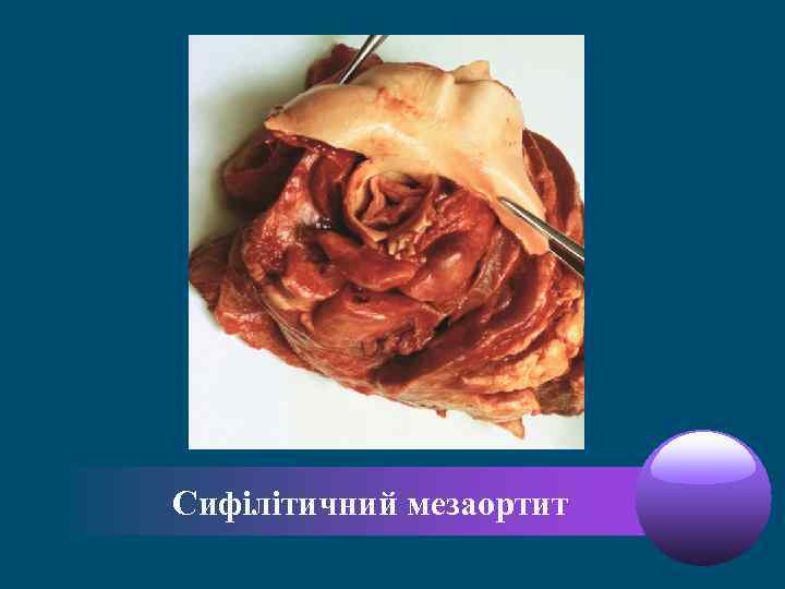 Сифілітичний мезаортит 