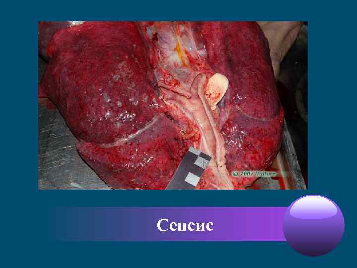 Сепсис 